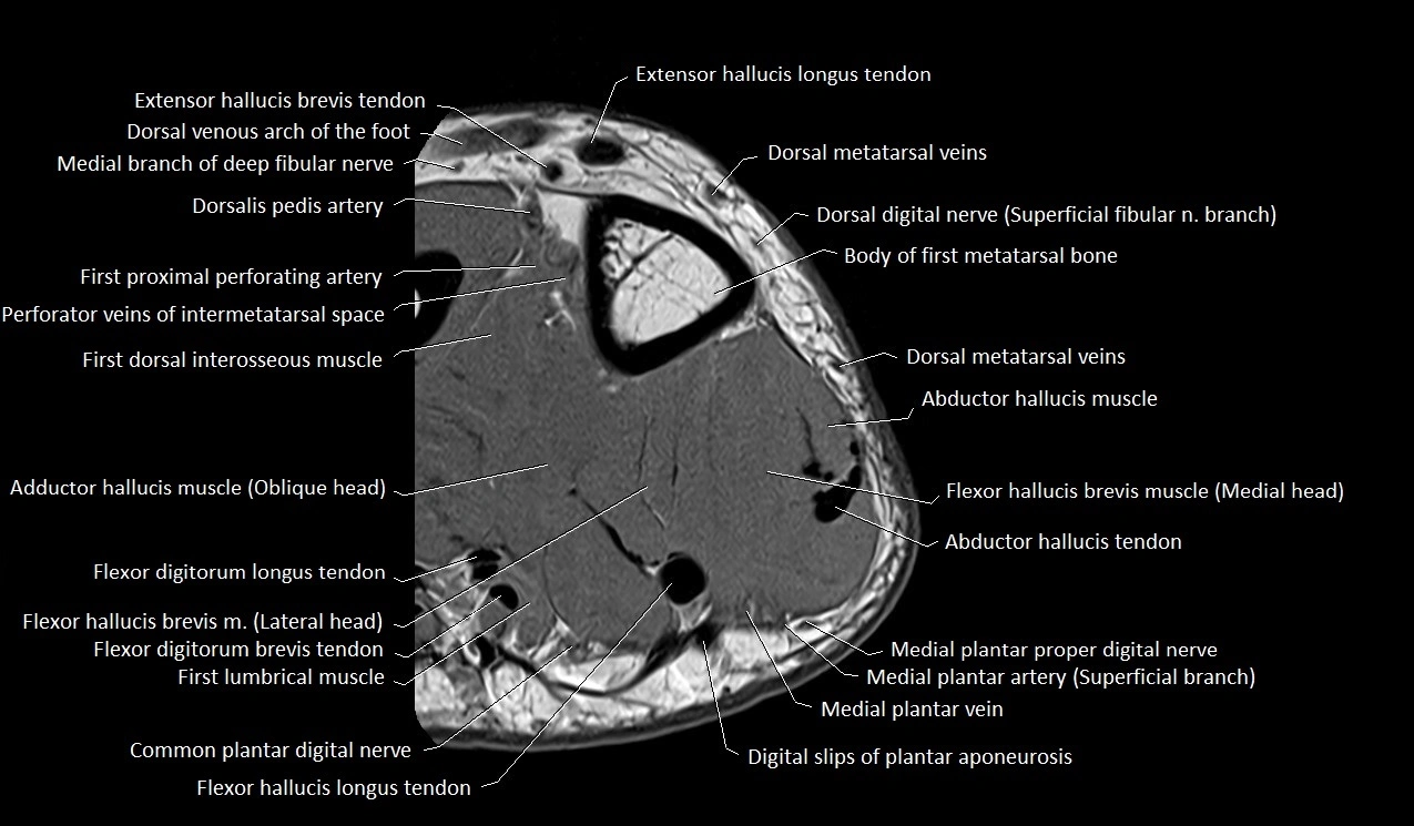 Great toe (hallux) axial microanatomy 3T MRI image 37.webp